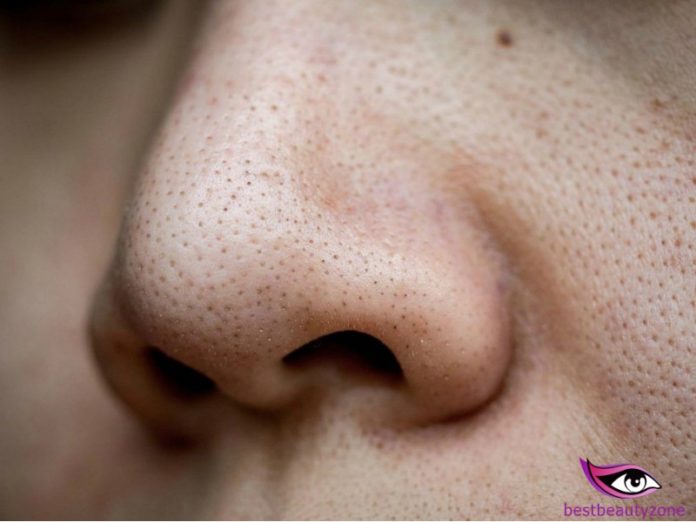 Clogged Pores on Nose