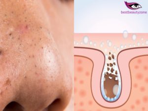 clogged pores in nose