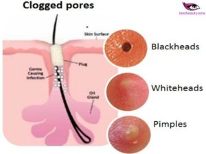 clogged pores on breast