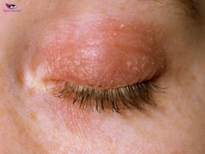 dry patch on eyelid