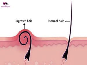 hair growing under skin
