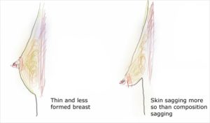 what causes sagging breast