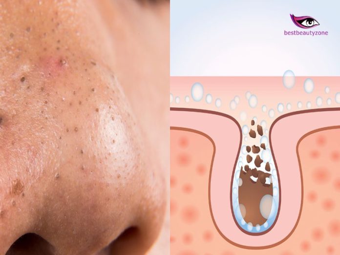 how to unclog pores on nose