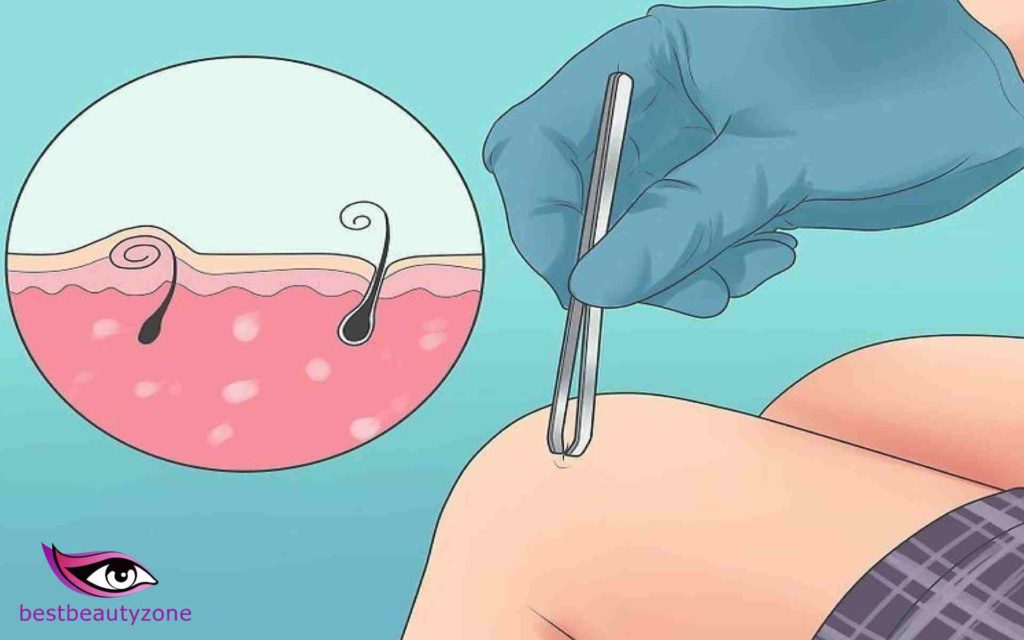 how to get rid of ingrown hair after waxing