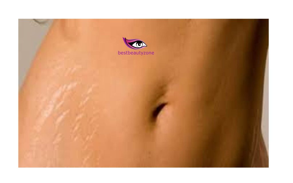 stomach stretch marks after weight loss