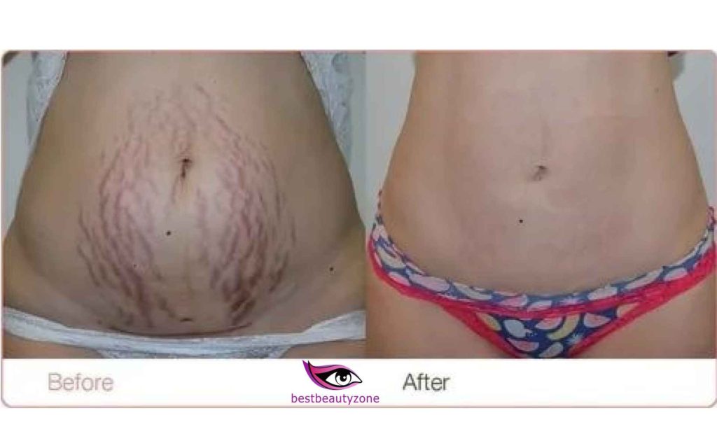 weight loss stretch marks before and after