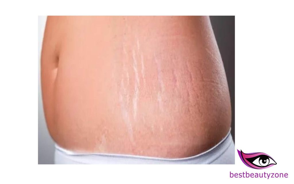 can i get rid of stretch marks by losing weight