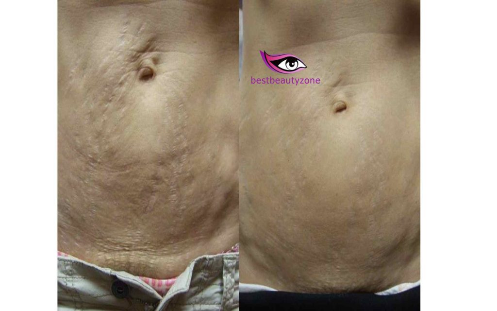 can weight loss cause stretch marks