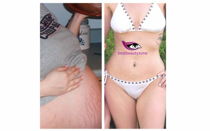 can you get stretch marks by losing weight