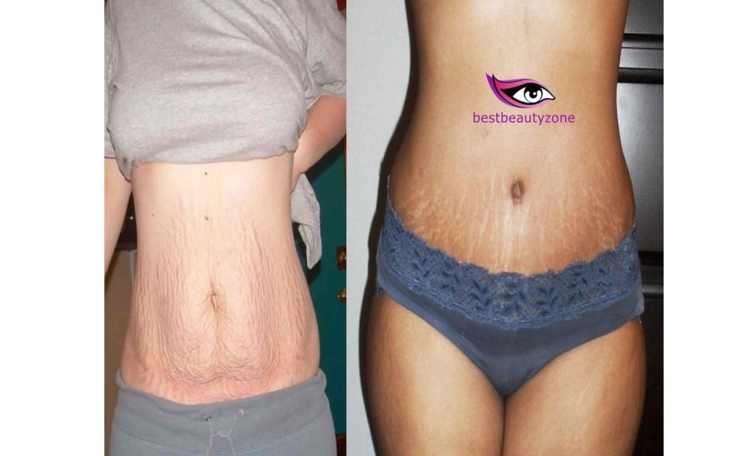 do you get stretch marks when you lose weight