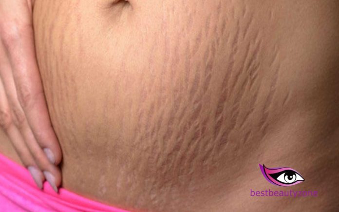 stretch marks from weight loss