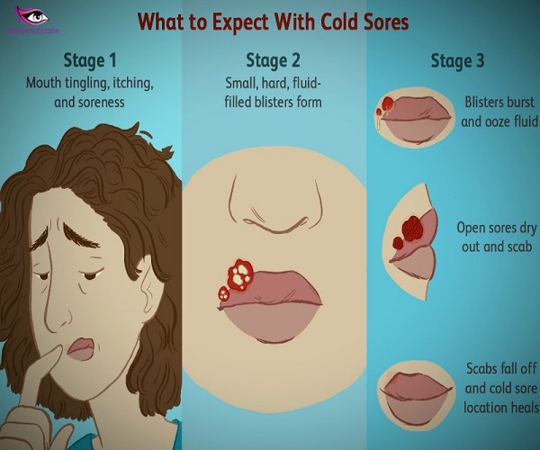 painful cold sore on lip