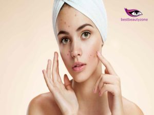 can acne scars go away