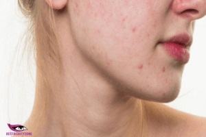 do pimple scars go away