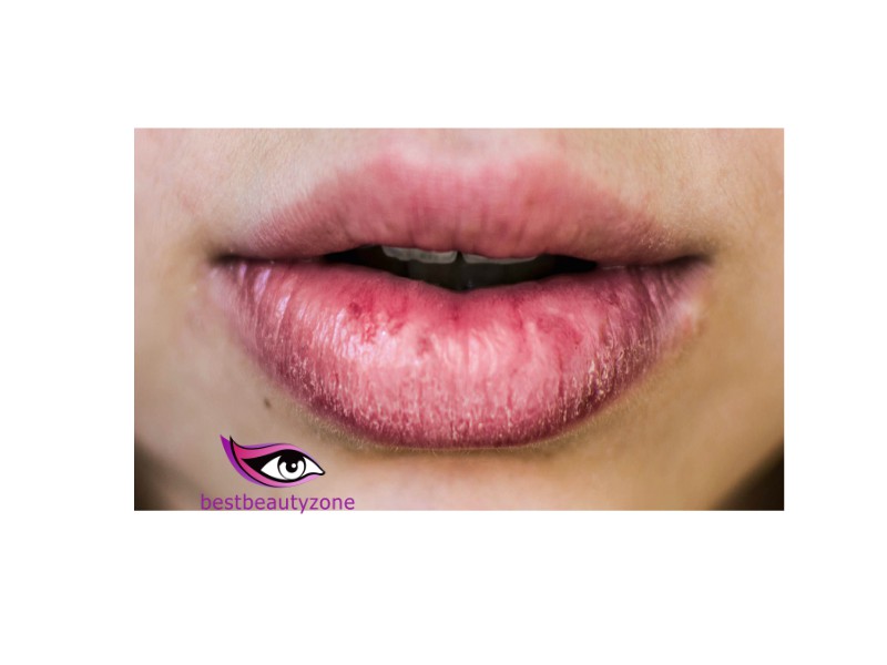 what causes lips to peel